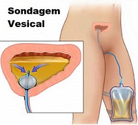 Sondagem visical